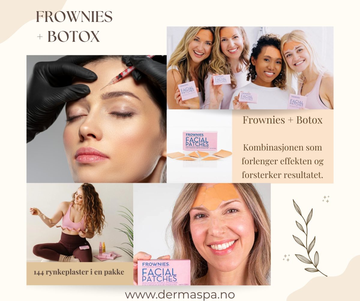 Frowniesbotox forlenger effekten001B